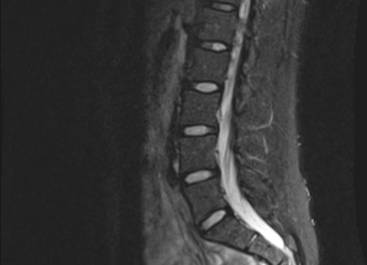 Can you work out with a herniated disc? - Tom Morrison