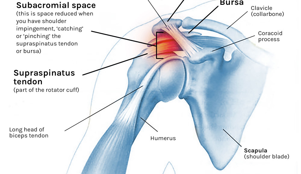 Shoulder impingement clearance syndrome