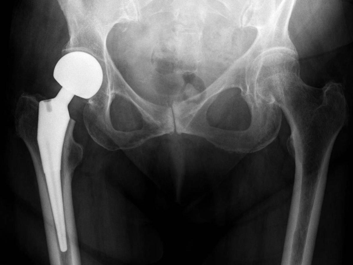 Is It Safe to Do Mobility with A Joint Replacement? - Tom Morrison