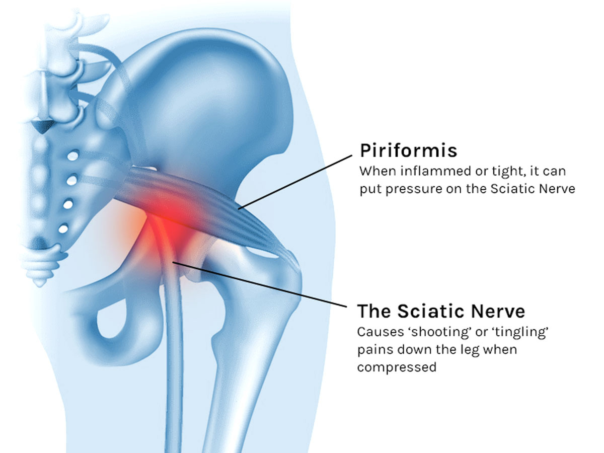 Causes of Piriformis Syndrome